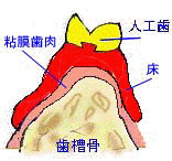 義歯3